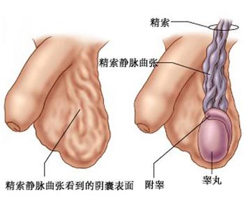 精索静脉曲张是怎么危害男性生育